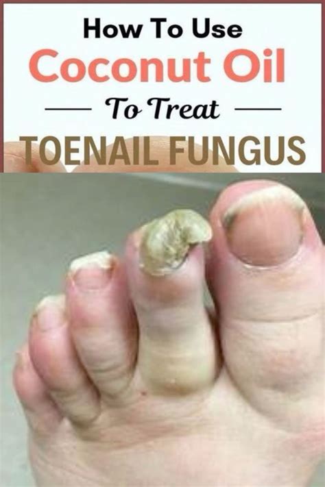 Homemade Foot Fungus Remedy