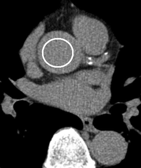 Variability of Repeated Coronary Artery Calcium Measurements on Low ...