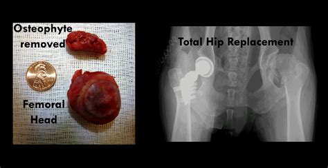 Hip Bone Spur Removal Surgery Video