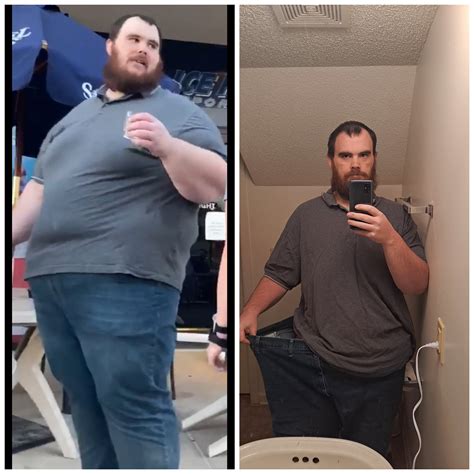 255 lbs down. 1 year post op. : r/wls