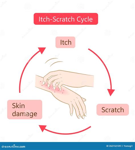 Itch Scratch Cycle Hands Dry, Dermatitis And Atopic Eczema , 42% OFF