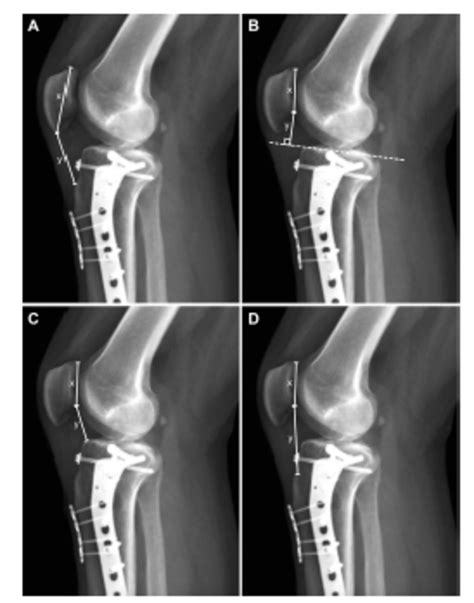 Open Tib Fib Fracture