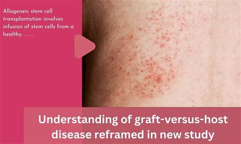 Understanding of graft-versus-host disease reframed in new study