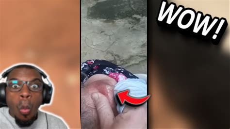 Image result for Largest Infected Exploding Cyst Carbuncle Blackhead