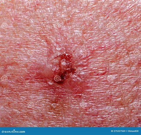 Cancer on the Scalp. Non-healing Skin Wound Stock Image - Image of nonhealing, mole: 275327569