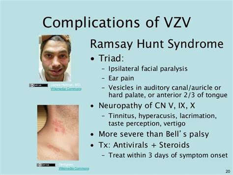 Ramsay Hunt Syndrome
