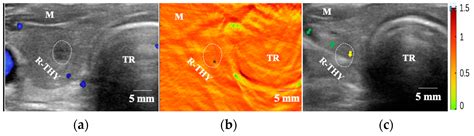 Photoacoustic Tomography Combined with Ultrasound Mapping for Guiding ...