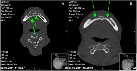 ‘Autoreconstruction’ of the Mandible—Report of a Case
