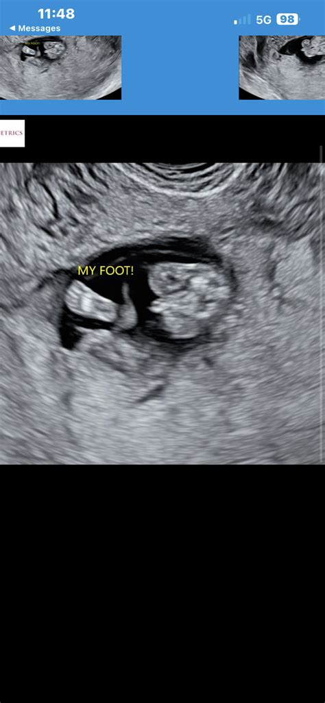 12 Weeks Pregnant Ultrasound