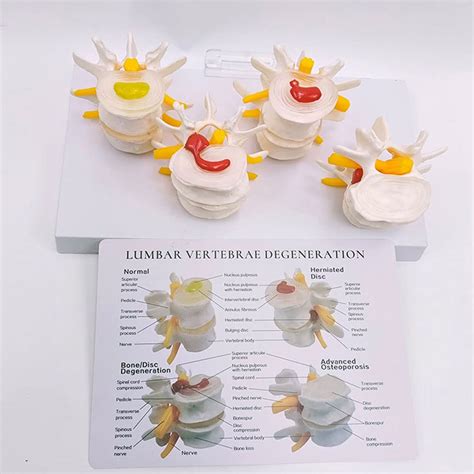 Buy Human 4 Stages Of Lumbar Spine Disease Model, Skeleton ...