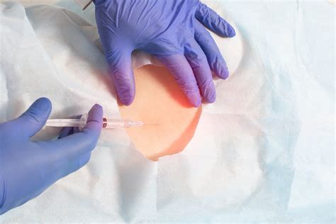 Image result for Epidural Injection Procedure