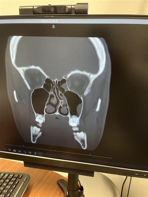 CT Scan of my Sinuses : r/Sinusitis