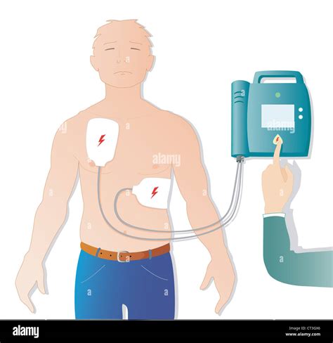 Automated External Defibrillator 的图像结果