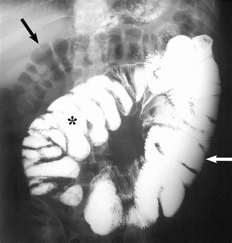 MRI Findings in Intestinal Cocoon | AJR