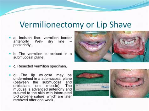 Dr. Rasel lip reconstruction cme DDCH, Dhaka, Bangladesh | PPTX