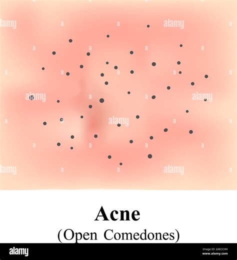 Closed comedo hi-res stock photography and images - Alamy
