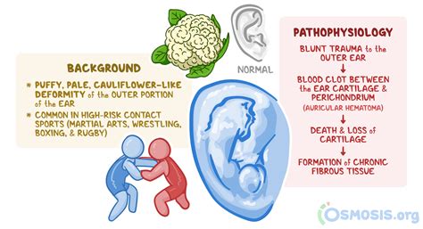 Cauliflower Ear: What Is It, Causes, Treatment, and More