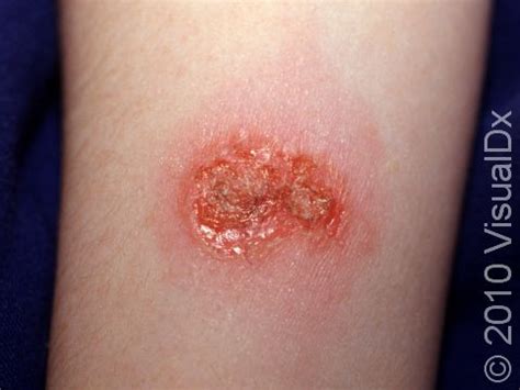 Impetigo: Types, Symptoms, Causes, And Treatment, 44% OFF