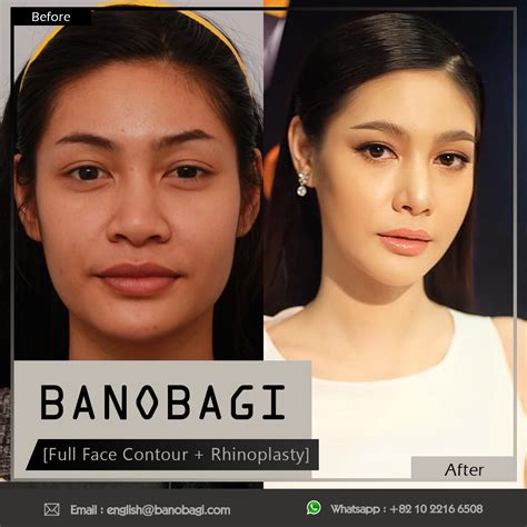 Korean Surgery, Korean Plastic Surgery, V Line Surgery, Facelift ...