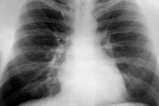 lung cancer photo all about asbestos exposure to diesel exhaust linked to lung cancer in lung cancer photo all about asbestos exposure to diesel exhaust linked to lung cancer in