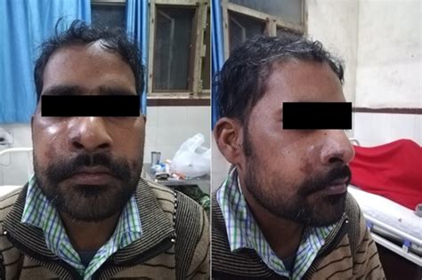 Acute invasive fungal rhinosinusitis presenting with subperiosteal ...