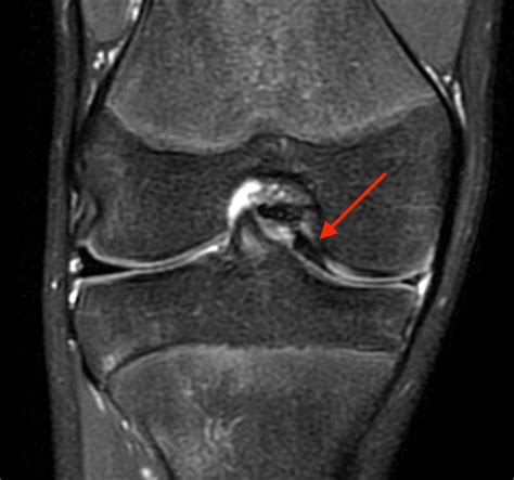 Bucket-handle Tear of the Meniscus - Radsource