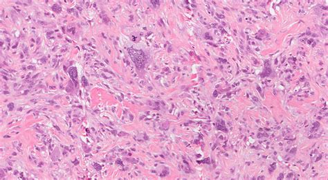 Your pathology report for spindle cell squamous cell carcinoma of the larynx – MyPathologyReport