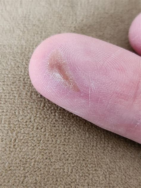 Bumps On Finger Tips Itchy at Paul Pineda blog