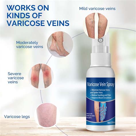 Buy Varicose Veins Treatment for Legs, Herbal Varicose Veins Spray ...