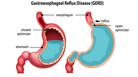 Can GERD Cause Blood in Mucus? – NutritionFact.in