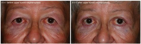 Clinical and Histopathological Features of Gelsolin Amyloidosis ...