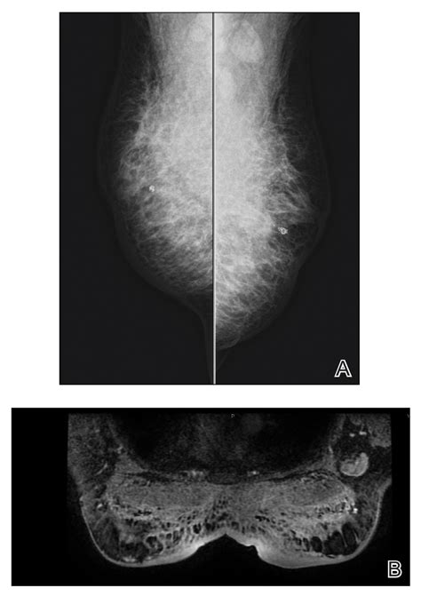 Fat Necrosis Breast Ultrasound