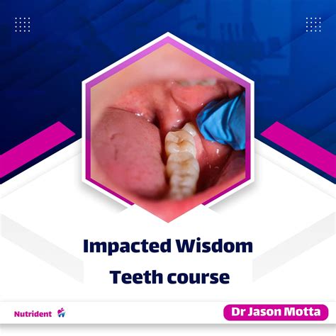 Impacted wisdom teeth course - Nutrident