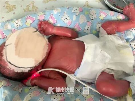 宝宝全身“油光光”像裹了一层羊皮纸！杭州一妈妈诞下“火棉胶婴儿”_杭州网新闻频道