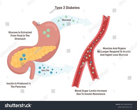 876 Type 2 Diabetes Pancreas Images, Stock Photos, 3D objects, & Vectors | Shutterstock