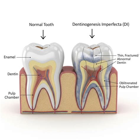 Dentinogenesis Imperfecta: Best Treatment Options Today - UNIDENTAL