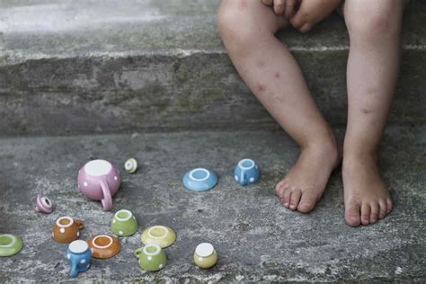 Bug Bite Bruise: How to Know What Insect Bit You