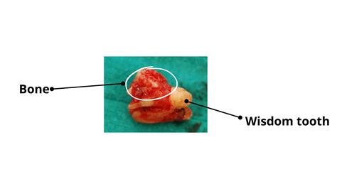 Tooth Extraction Complications: A Comprehensive Guide with Pictures
