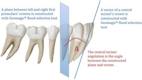 The predictability of the mandibular curve of Spee leveling with the ...