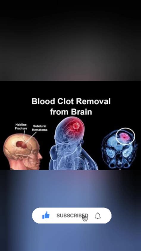 When blood clots in human brain. treatment - One News Page VIDEO