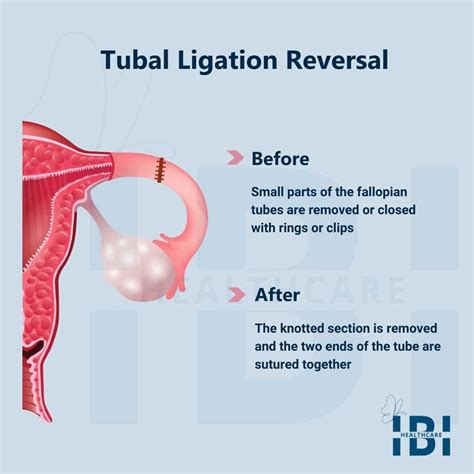 Tubal Ligation Icd 10