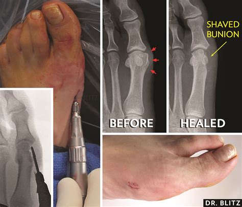 Bunion Removal Doctors at Johanna Reed blog