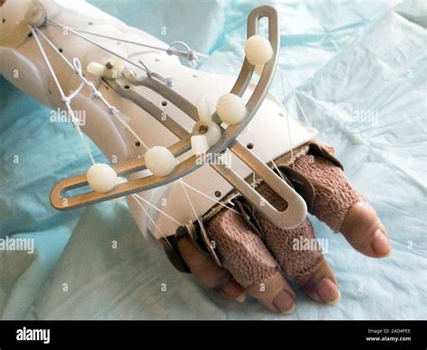 Hand joint replacement. Close-up a dorsiflexion splint on a patient's hand following surgery to ...