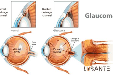 Image result for Peripheral Vision Loss