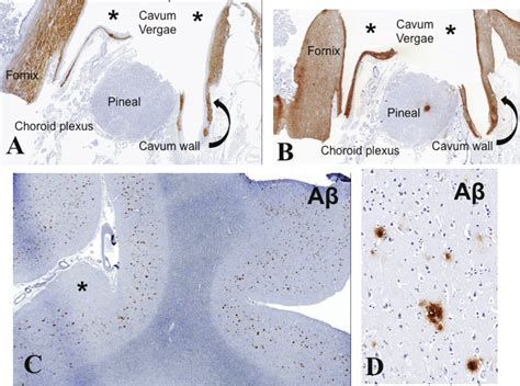 Cavum Septi Pellucidi and Cavum Vergae With Increased Amyloid β Cortical Load in a 65-Year-Old ...