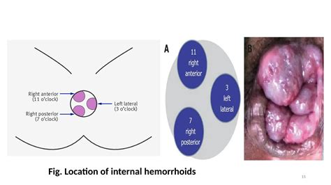 Benign anorectal disorders: Hemorrhoids, anal fissure, SRUS, Perianal ...