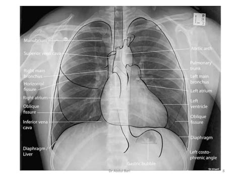 Image result for Chest X-Ray Tutorial