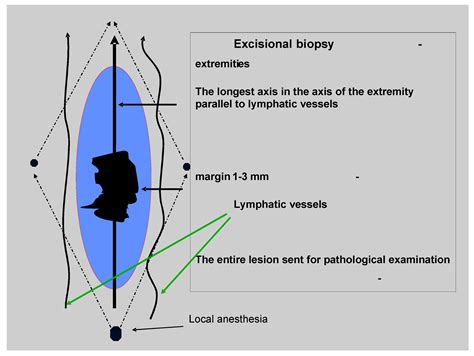 Melanoma Wide Local Excision at Catrina Franzen blog