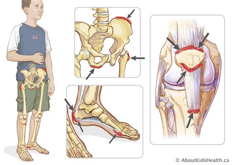 Juvenile enthesitis-related arthritis (ERA) - Arthritis WA