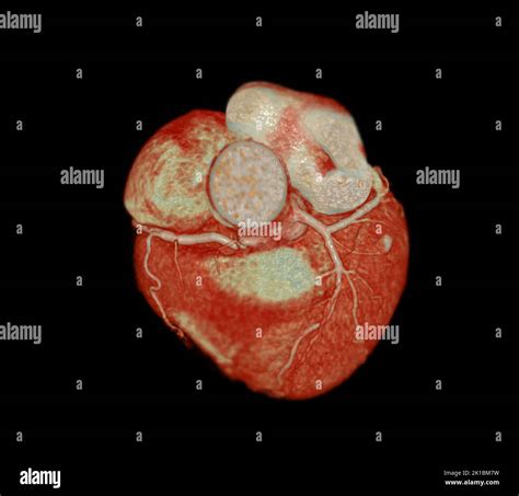 CT Cardiac 3D or CTA coronary artery for prevention coronary artery diseases Stock Photo - Alamy